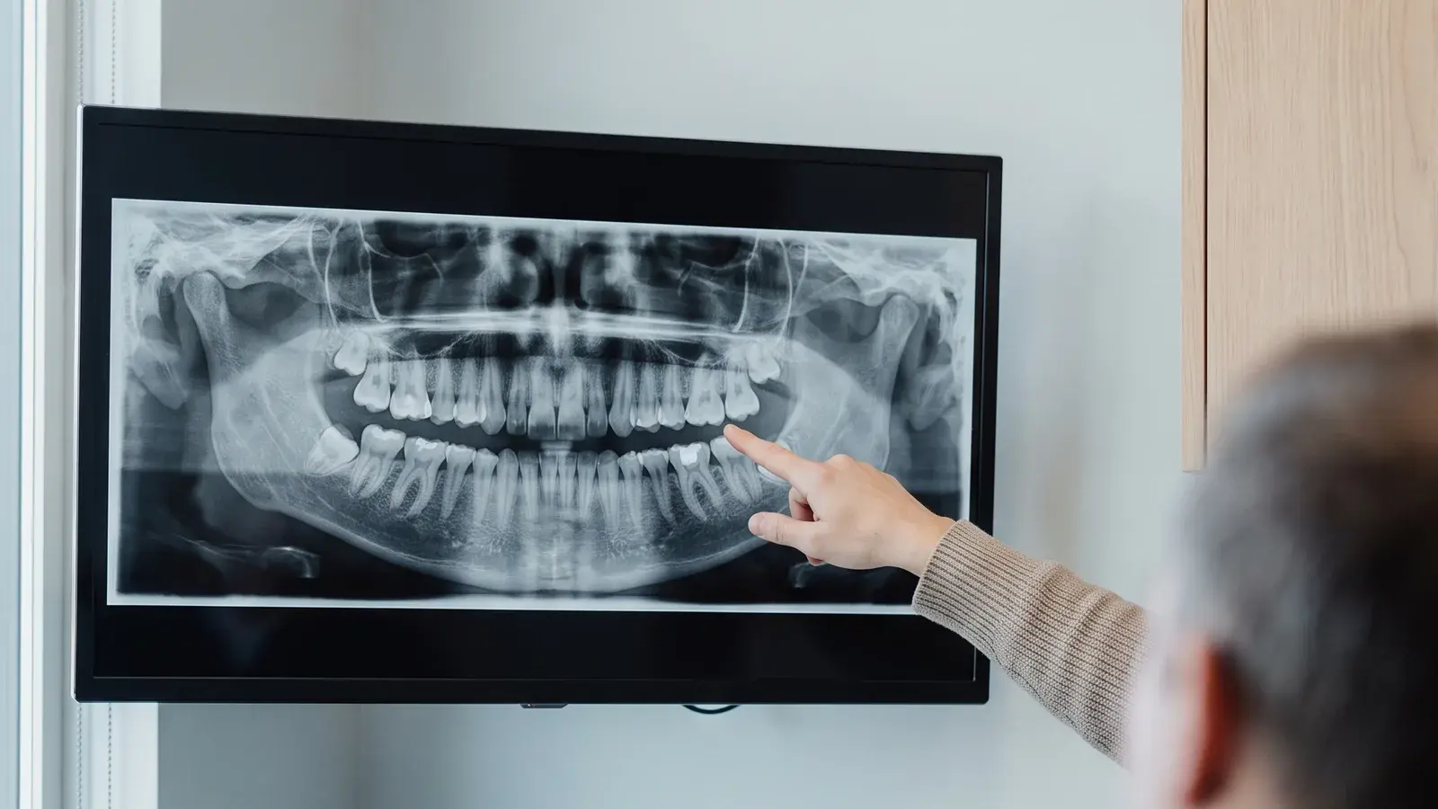 A panoramic dental X-ray on a wall-mounted screen, a hand pointing to one lower molar, with a patient seated in the foreground seen from behind